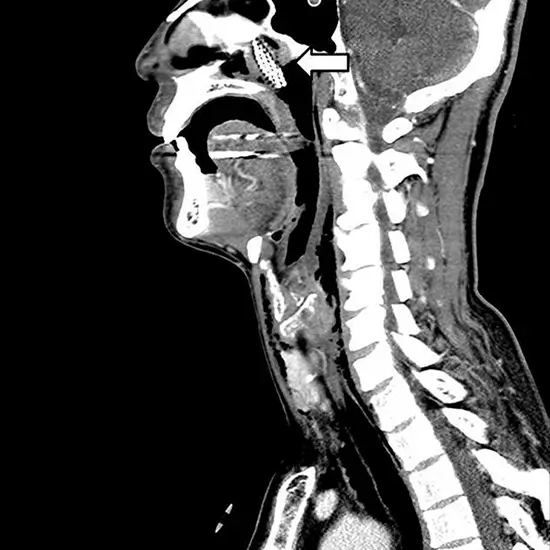 MRI NecK and PNS